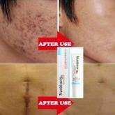 2-Nuobisong creme de tratamento Facial para tratar a Acne cicatrizes queimadura estrias da gravidez